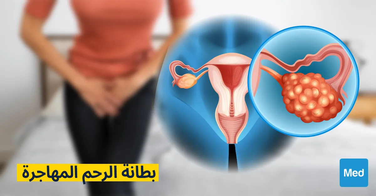 بطانة الرحم المهاجرة